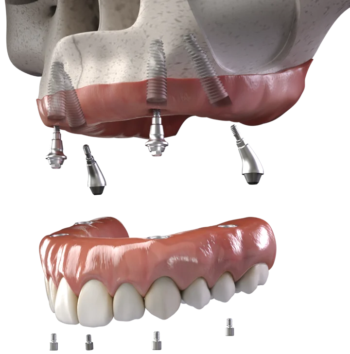 All-on-4 / Full Arch