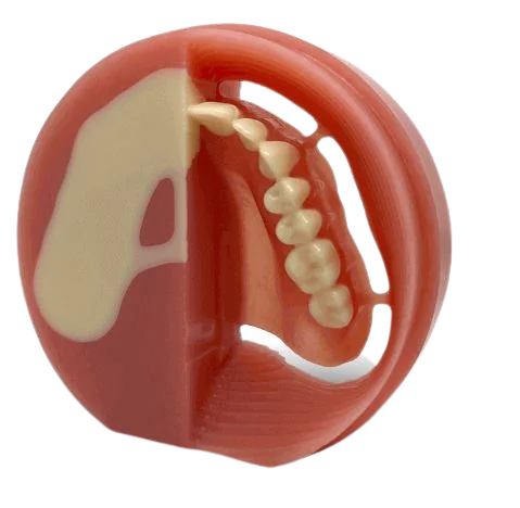 Implant-Supported Dentures