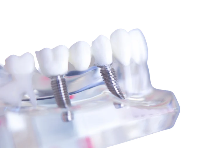Dental Implants