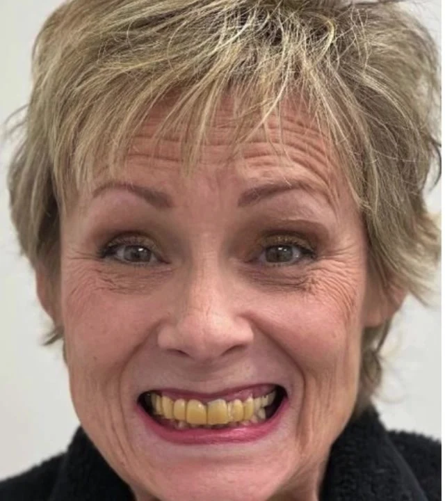 Smile Again NJ patient before treatment — case 1