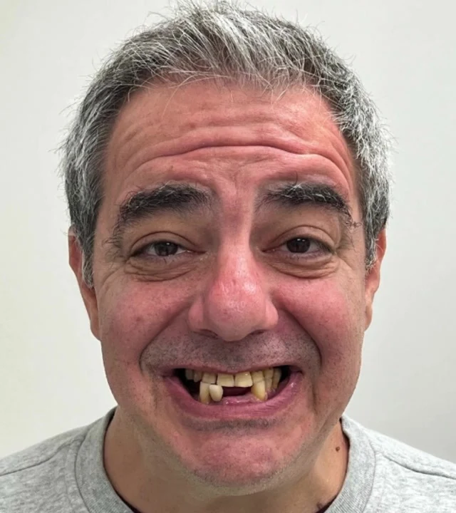 Smile Again NJ patient before treatment — case 2