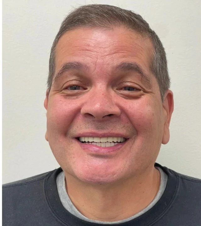Smile Again NJ patient after treatment — case 4