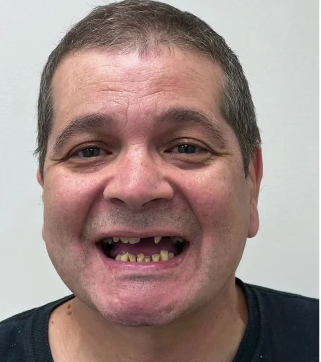 Smile Again NJ patient before treatment — case 4