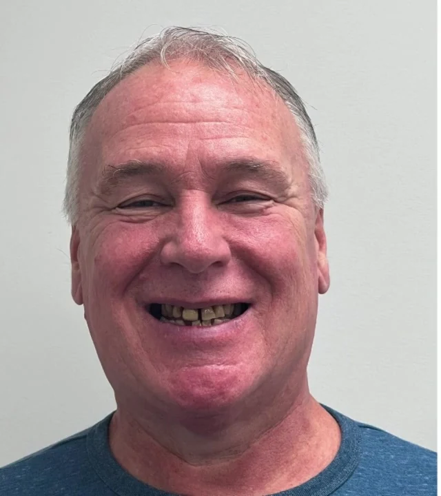 Smile Again NJ patient before treatment — case 6