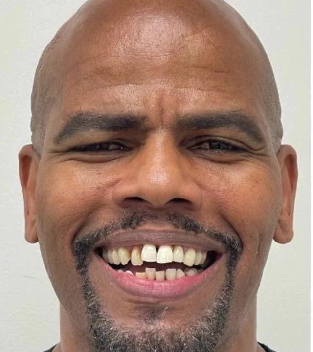 Smile Again NJ patient before treatment — case 7