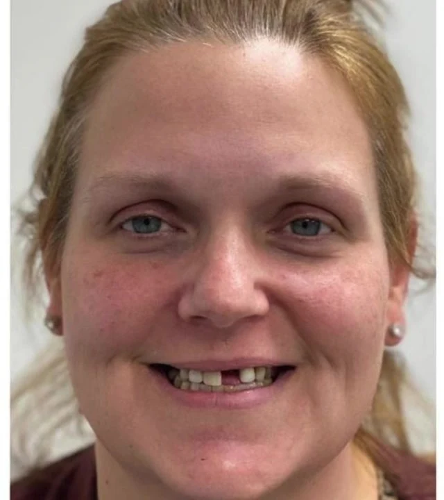 Smile Again NJ patient before treatment — case 10