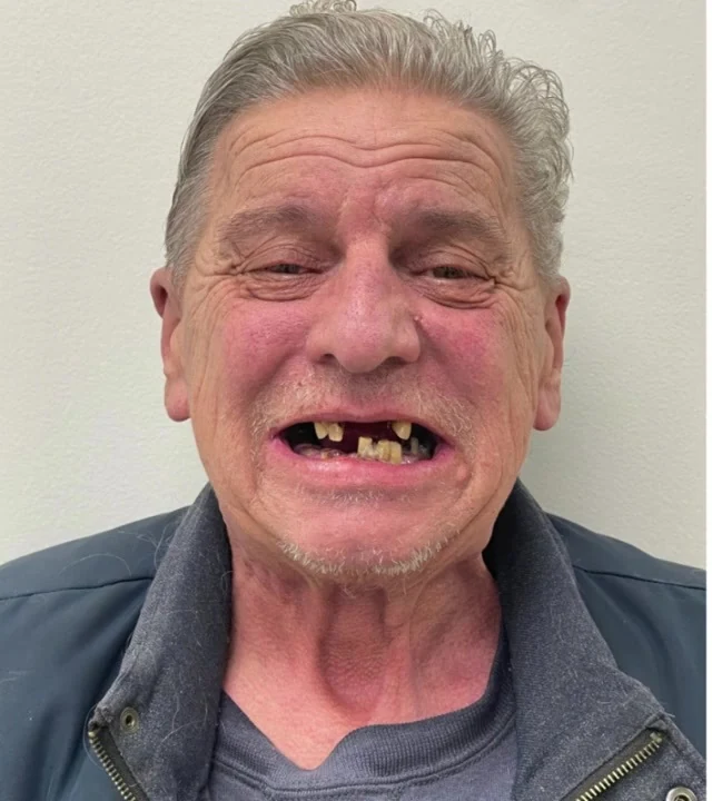 Smile Again NJ patient before treatment — case 12